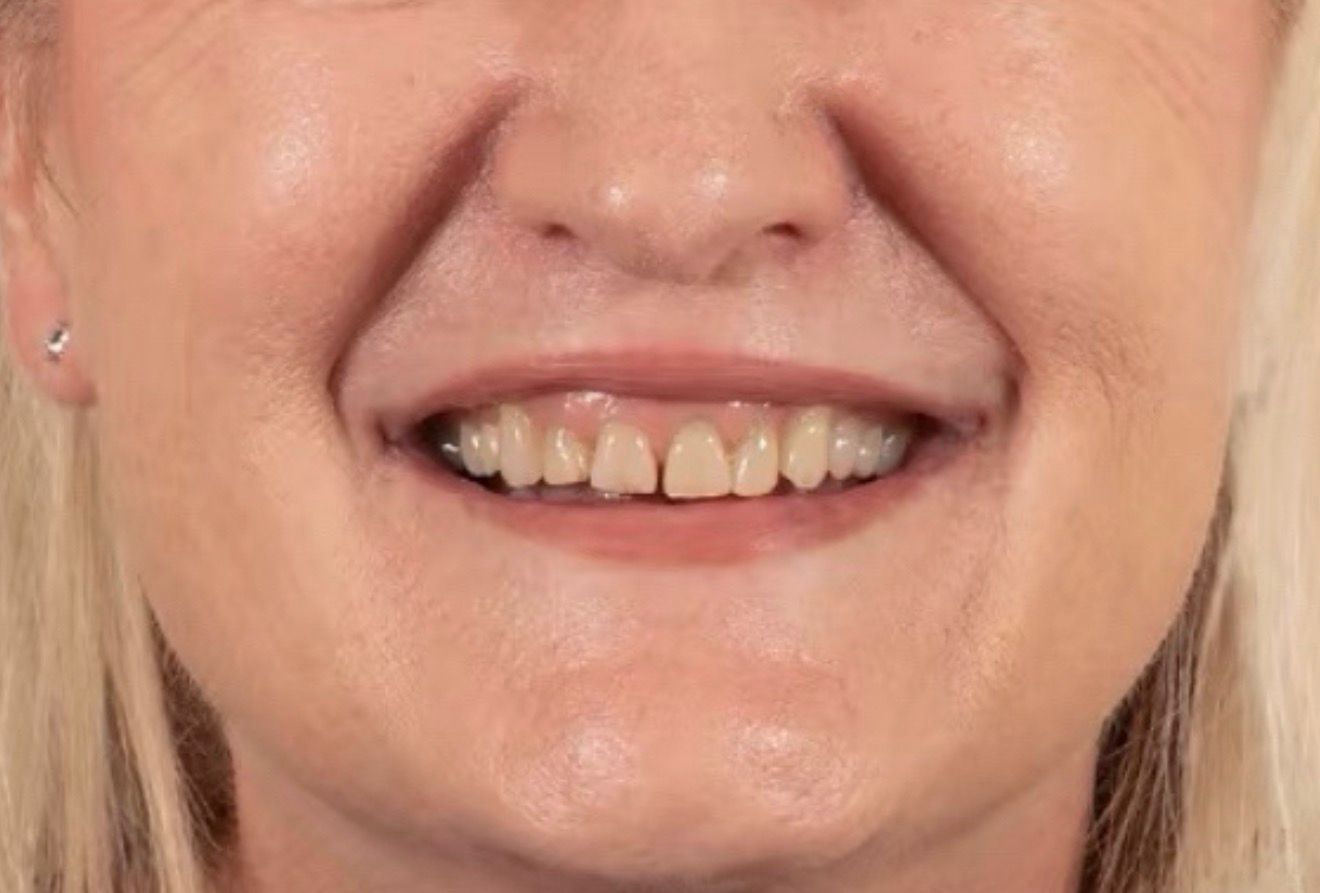 Улыбка до и после лечения - до