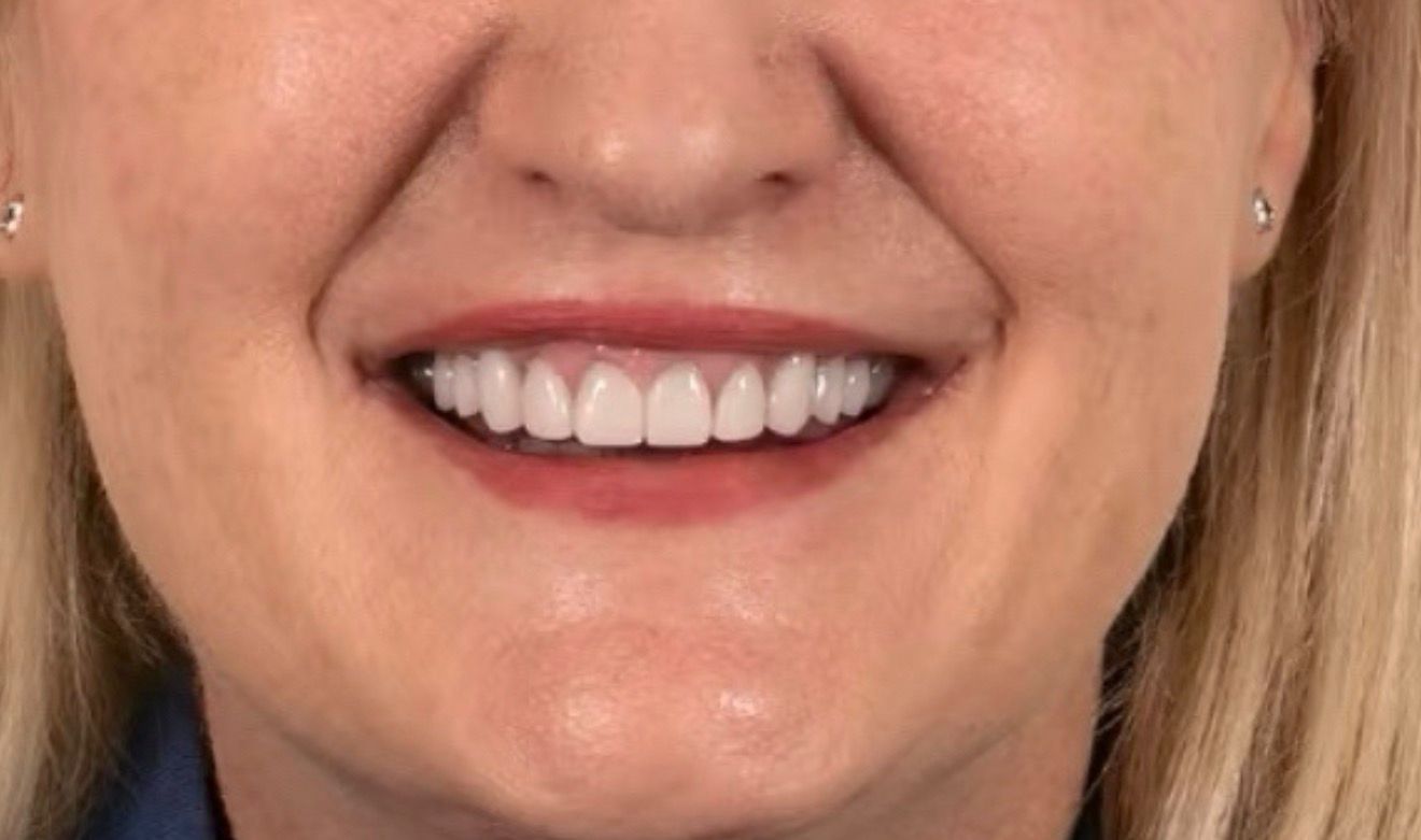 Улыбка до и после лечения - после